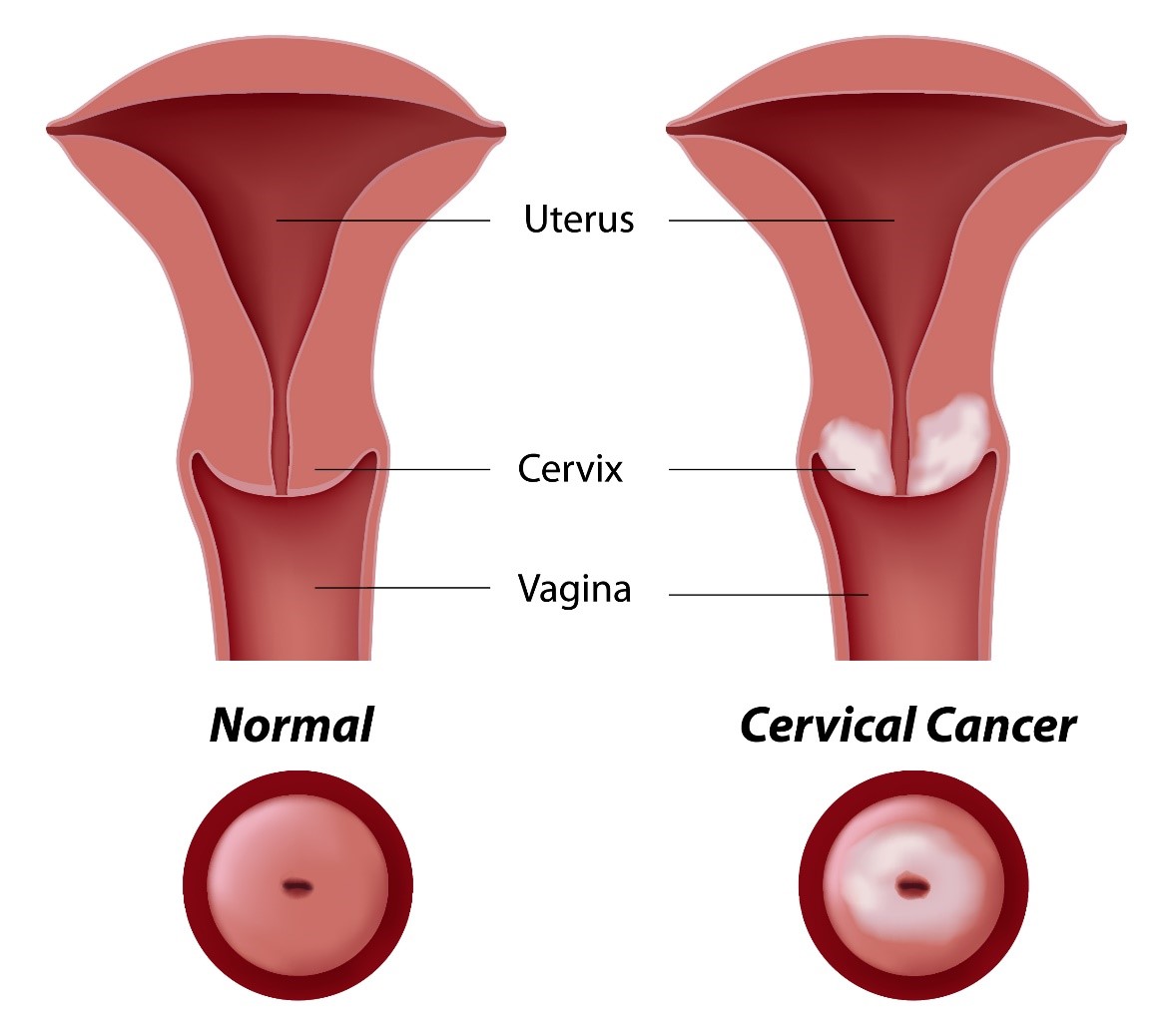 Cervical Cancer Symptoms Dr Lal Pathlabs Blog 1586