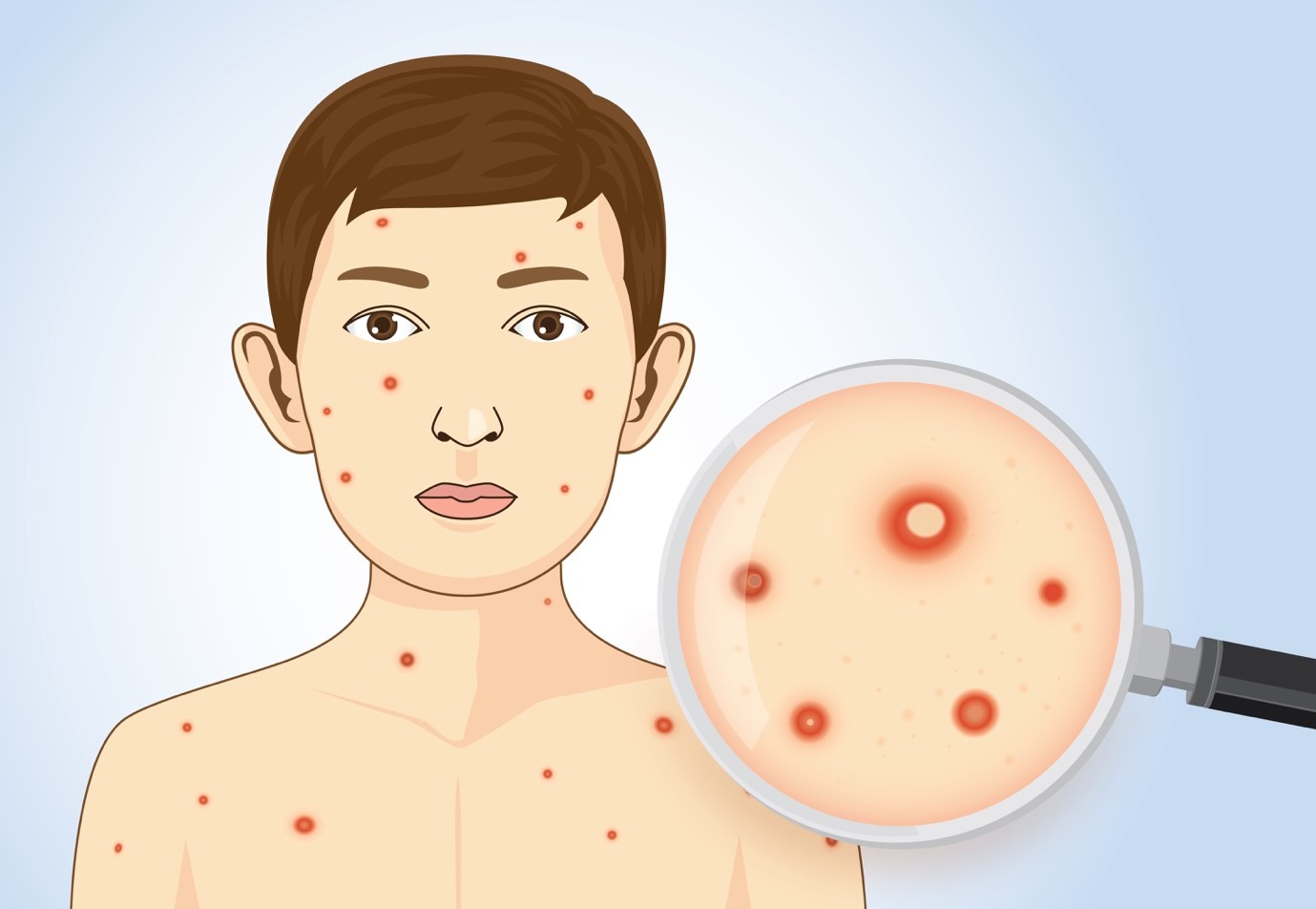 causes of chicken pox
