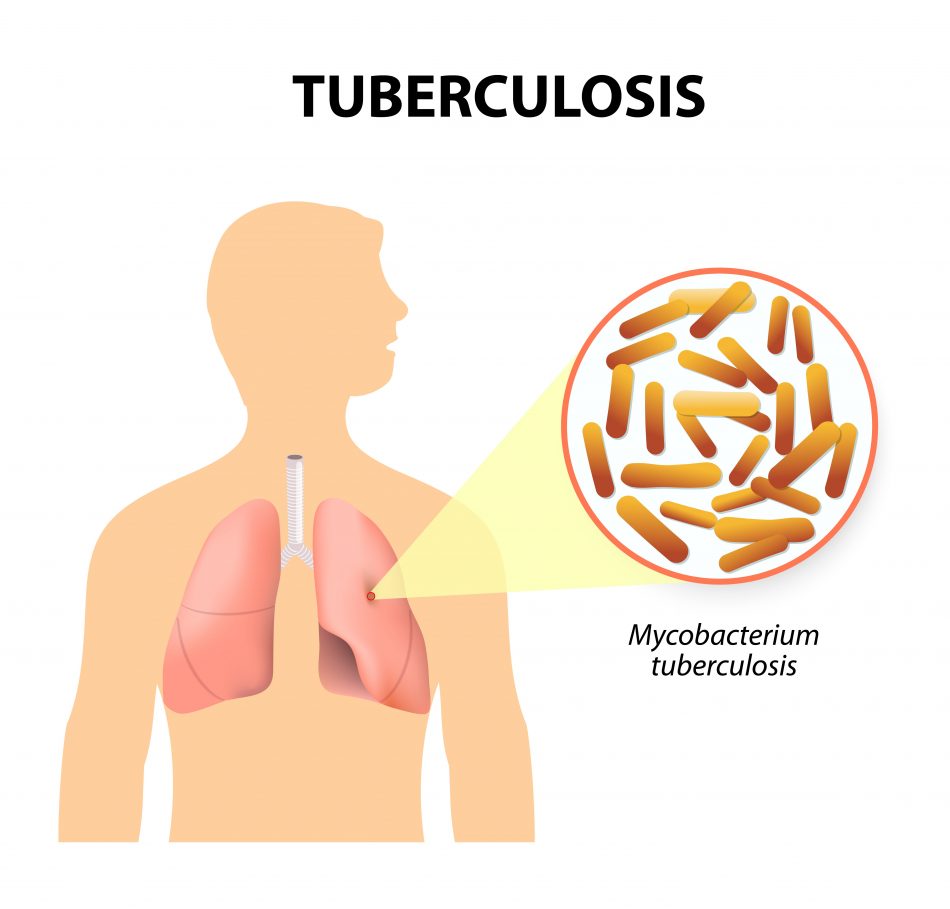 What you know about Tuberculosis (TB)? , How is it treated?