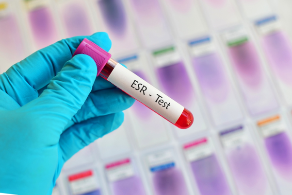 ESR (Erythrocyte Sedimentation Rate): Testing, Levels & More