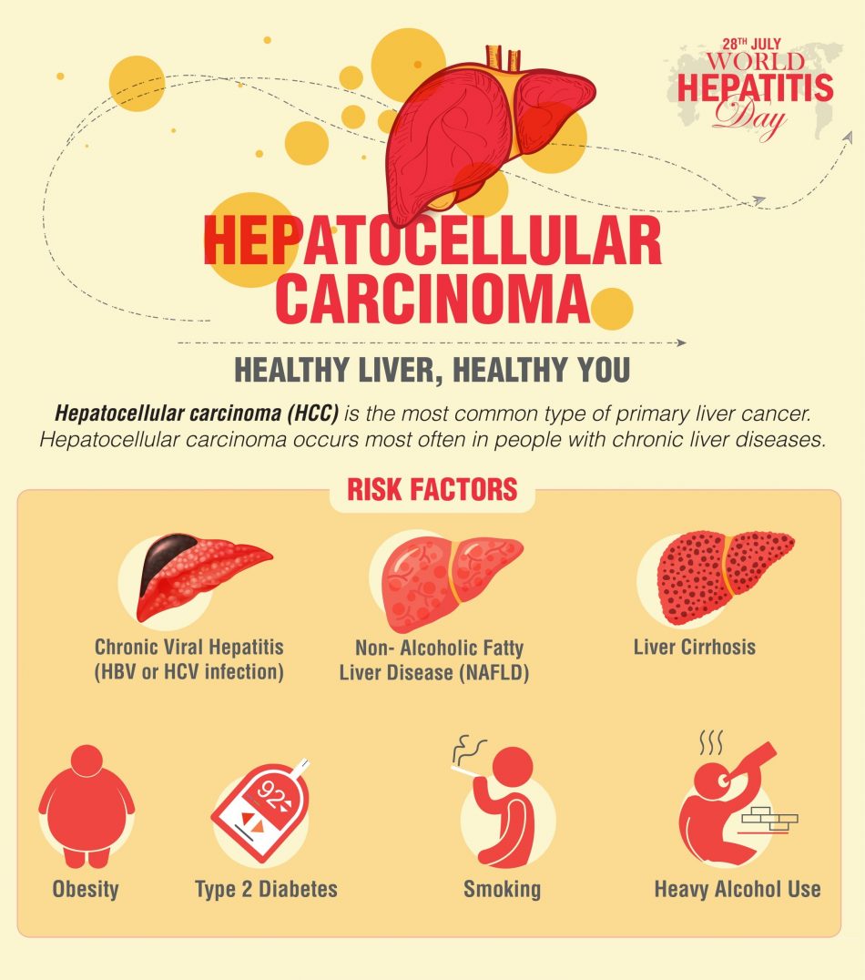 World Hepatitis Day - Hepatocellular Carcinoma Symptoms And Causes | Dr ...