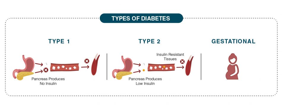 overview-of-diabetes-types-diet-plan-and-food-chart