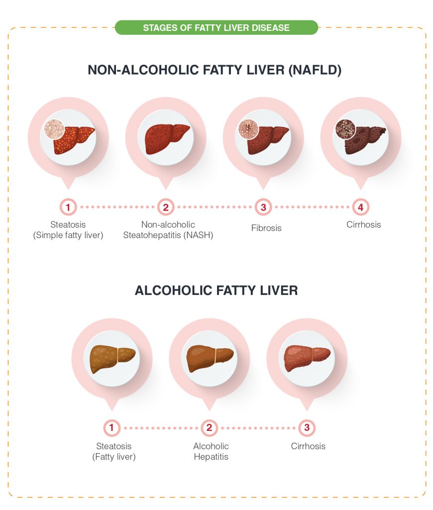 Fatty Liver Levels Chart