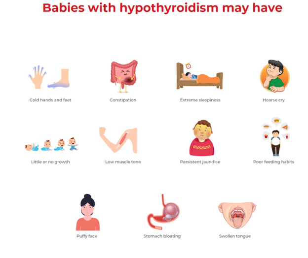 babies with hypothyroidism