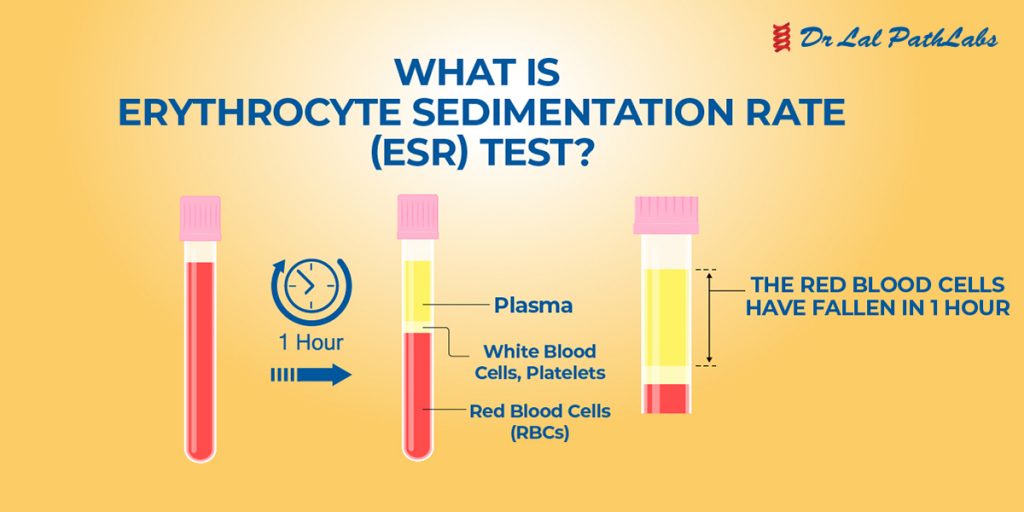 Associations Between Extreme Erythrocyte Sedimentation Rate Elevations