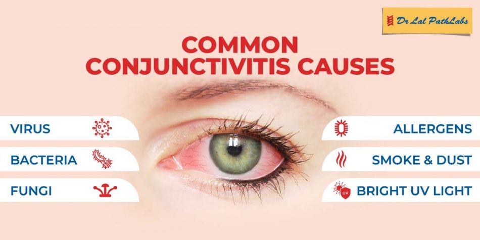 Conjunctivitis Causes Symptoms And Types Dr Lal Pathlabs 