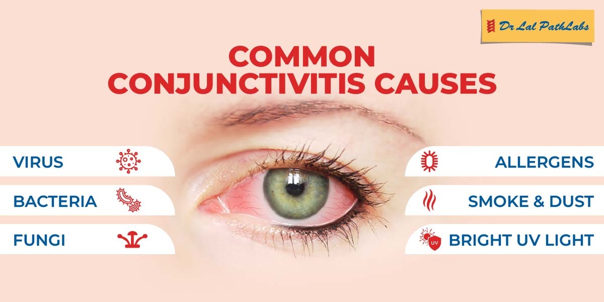 Conjunctivitis: Causes, Symptoms, and Types | Dr. Lal PathLabs